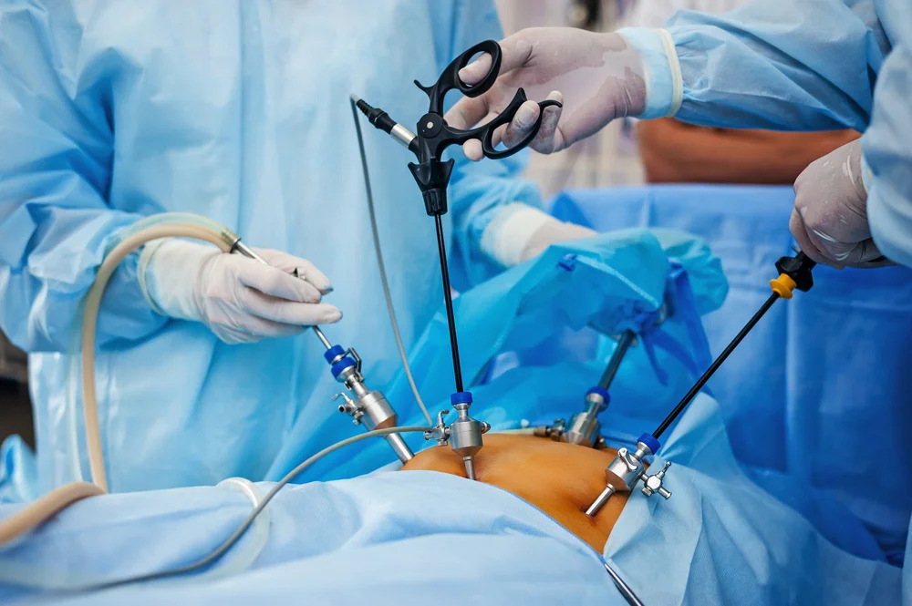 Laparoscopic Surgeries